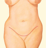 Tummy Tuck, Exterior Incision