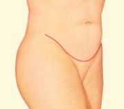 Tummy Tuck, Lower Incision