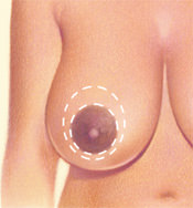 Breast Reduction - Circular Pattern, Before