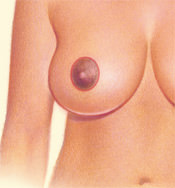Breast Reduction - Circular Pattern, After
