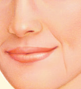 Lip Augmentation, Before