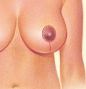 Breast Reduction - Anchor Shaped Incision, After