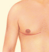 Excision, Liposuction, Incision
