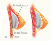Inserting Breast Implants
