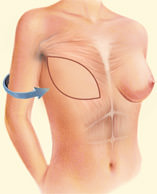 Complete Breast Mound, Muscle